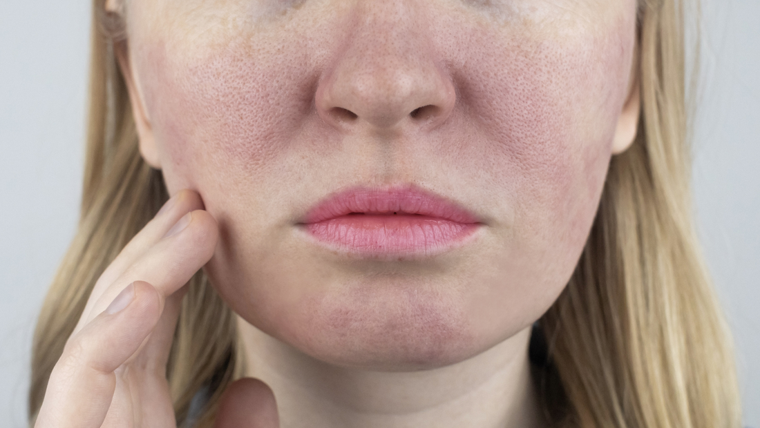 Sfoghi sul viso: irritazioni e pelle secca